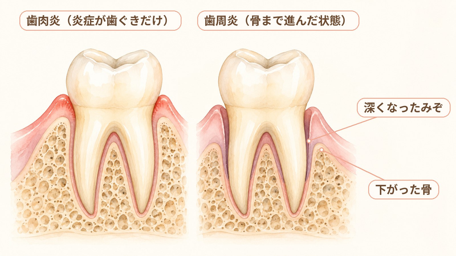 歯と歯ぐきの断面を説明するための図。左は歯肉炎で、歯ぐきの縁だけが腫れていて、歯を支える骨は高い位置まである。右は歯周炎で、歯と歯ぐきのあいだのみぞ(歯周ポケット)が深くなり、歯を支える骨が下がっている